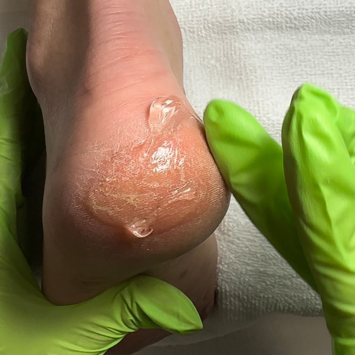 gel esfoliante acid piedi farmona