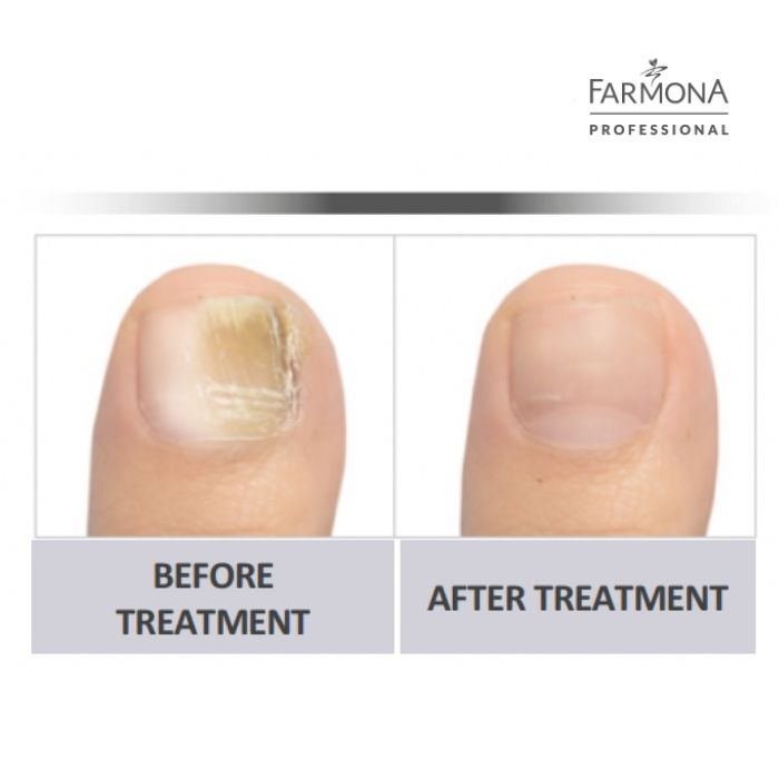 prima dopo trattamento anti micotico eniinails
