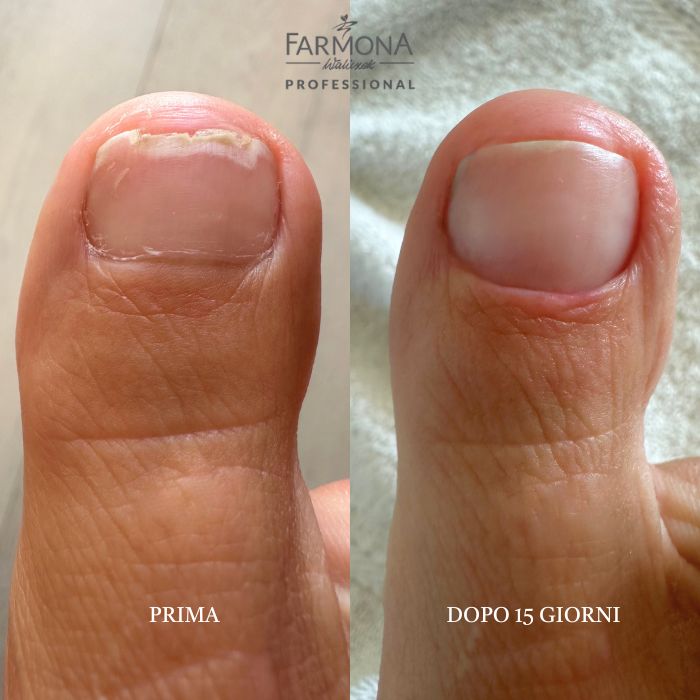 prima e dopo unghie con onicolisi trattamento siero famona