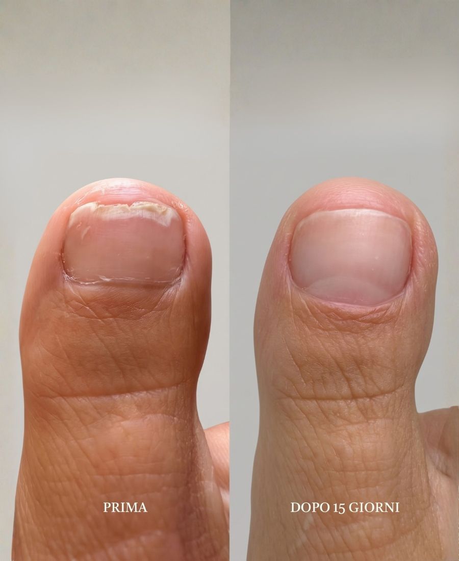 PODOLOGIC MEDICAL - siero oleoso per unghie con sintomi di onicolisi