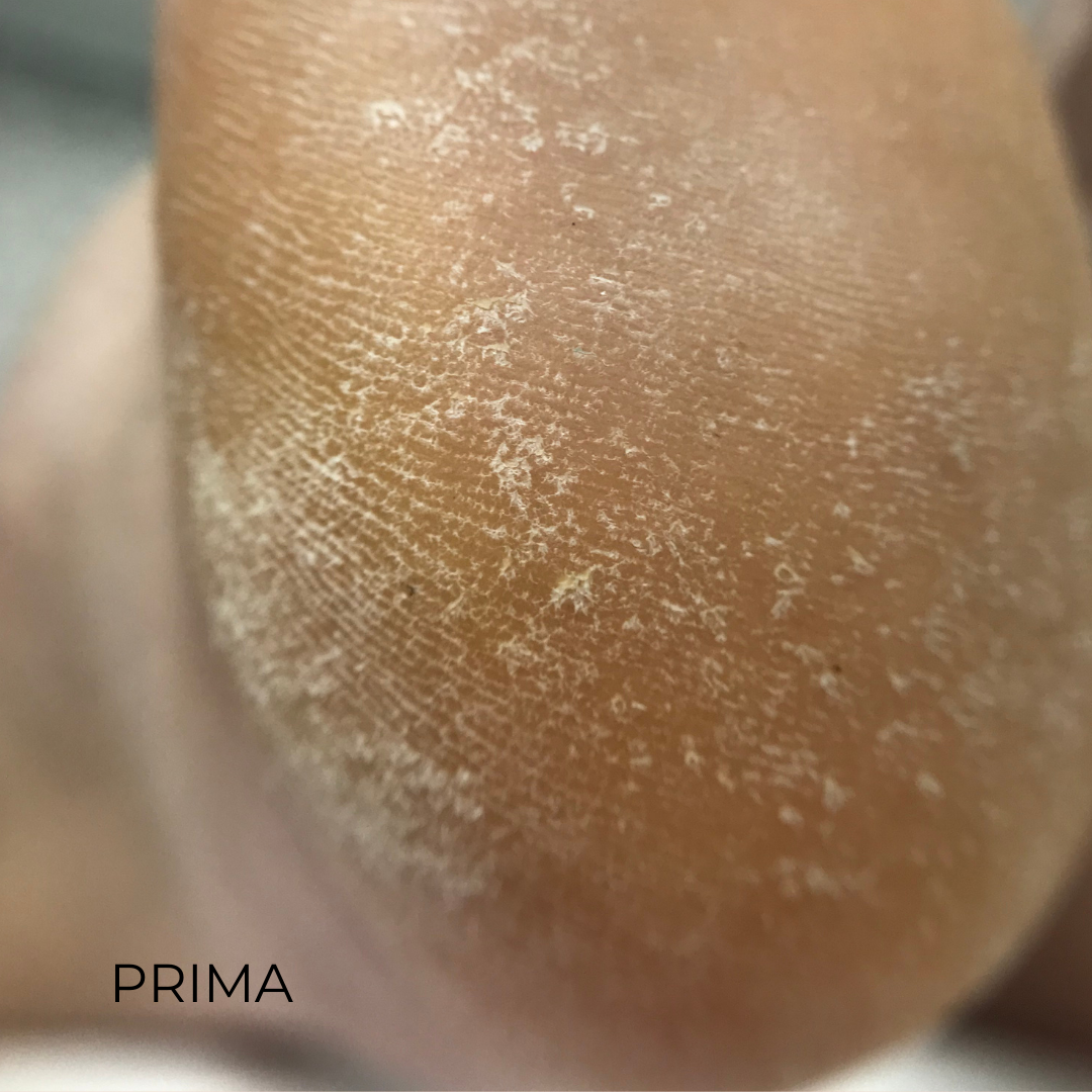 PODOLOGIC ACID - Gel esfoliante piedi