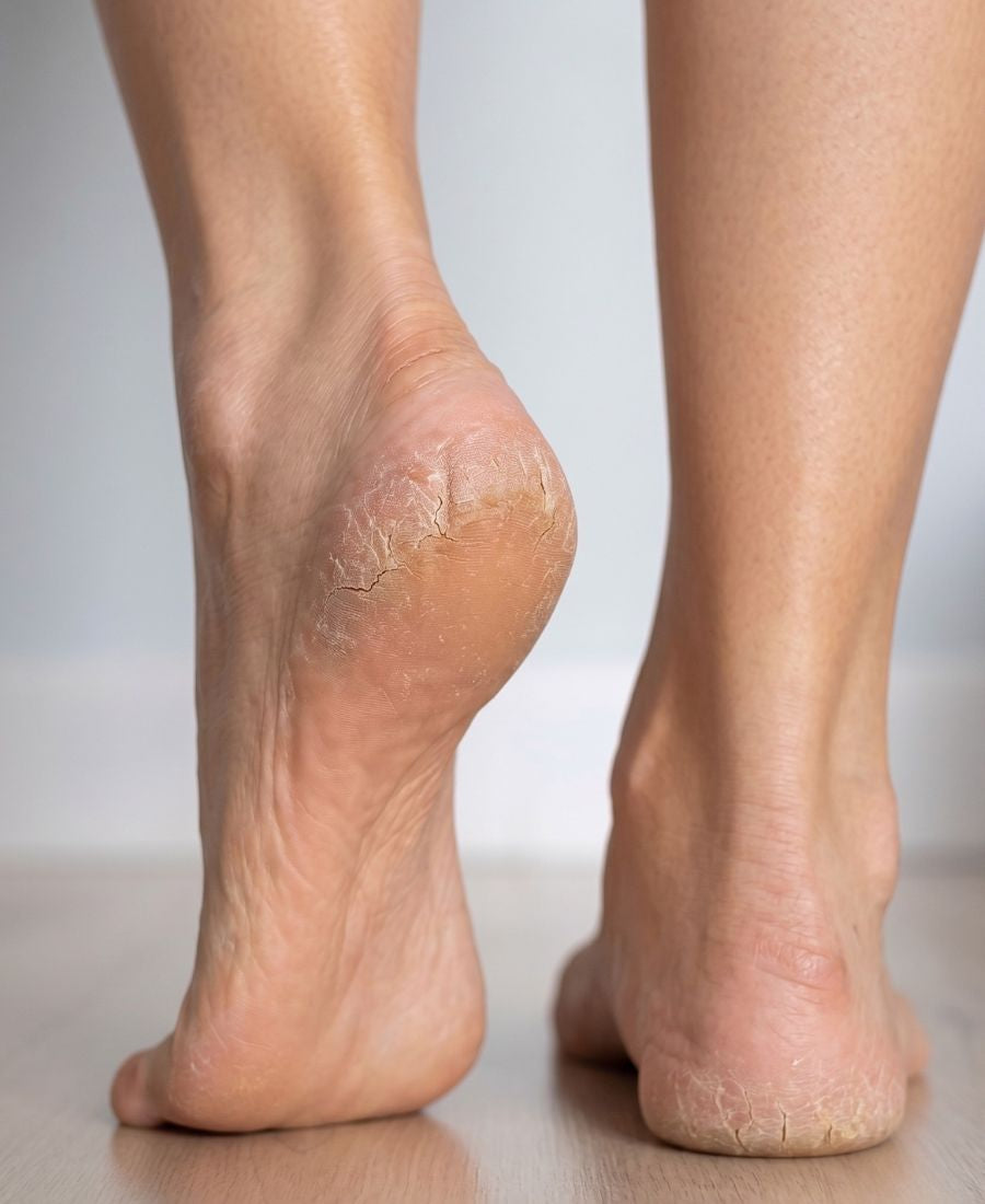The Feet Coach - ROLL ON ACID PEEL piedi ruvidi