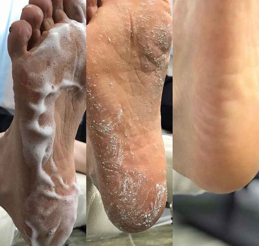 PODOLOGIC HERBAL - schiuma emolliente intensiva piedi urea 30%