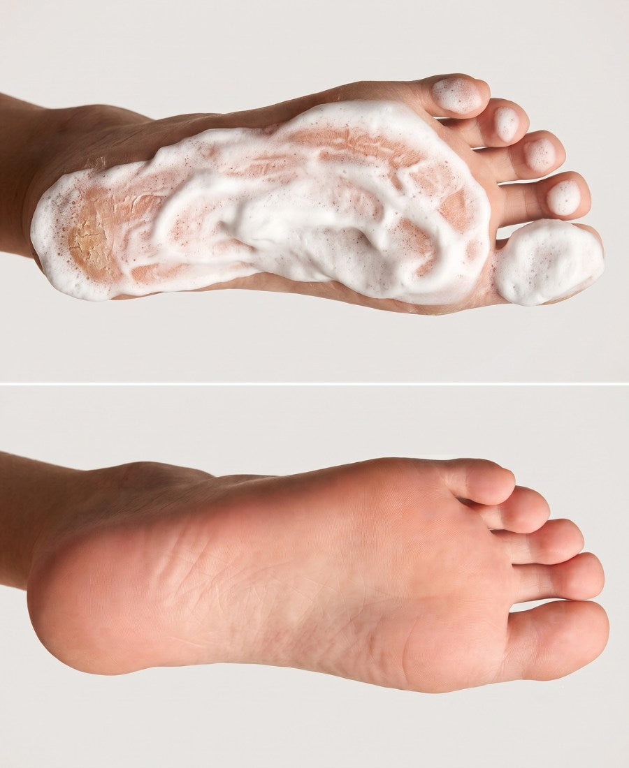 PODOLOGIC HERBAL - schiuma emolliente intensiva piedi urea 30%